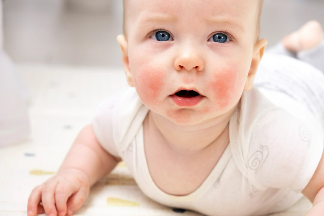 Baby with mild eczema